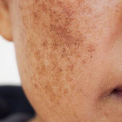 Taches brunes et hyperpigmentation