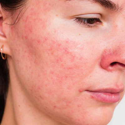 Cicatrices d’acné et imperfections